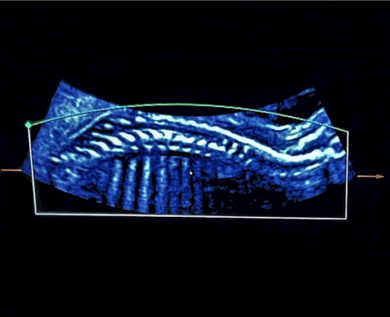 Does 3D imaging of the fetal spine improve confidence in interpreting images in the second trimester?